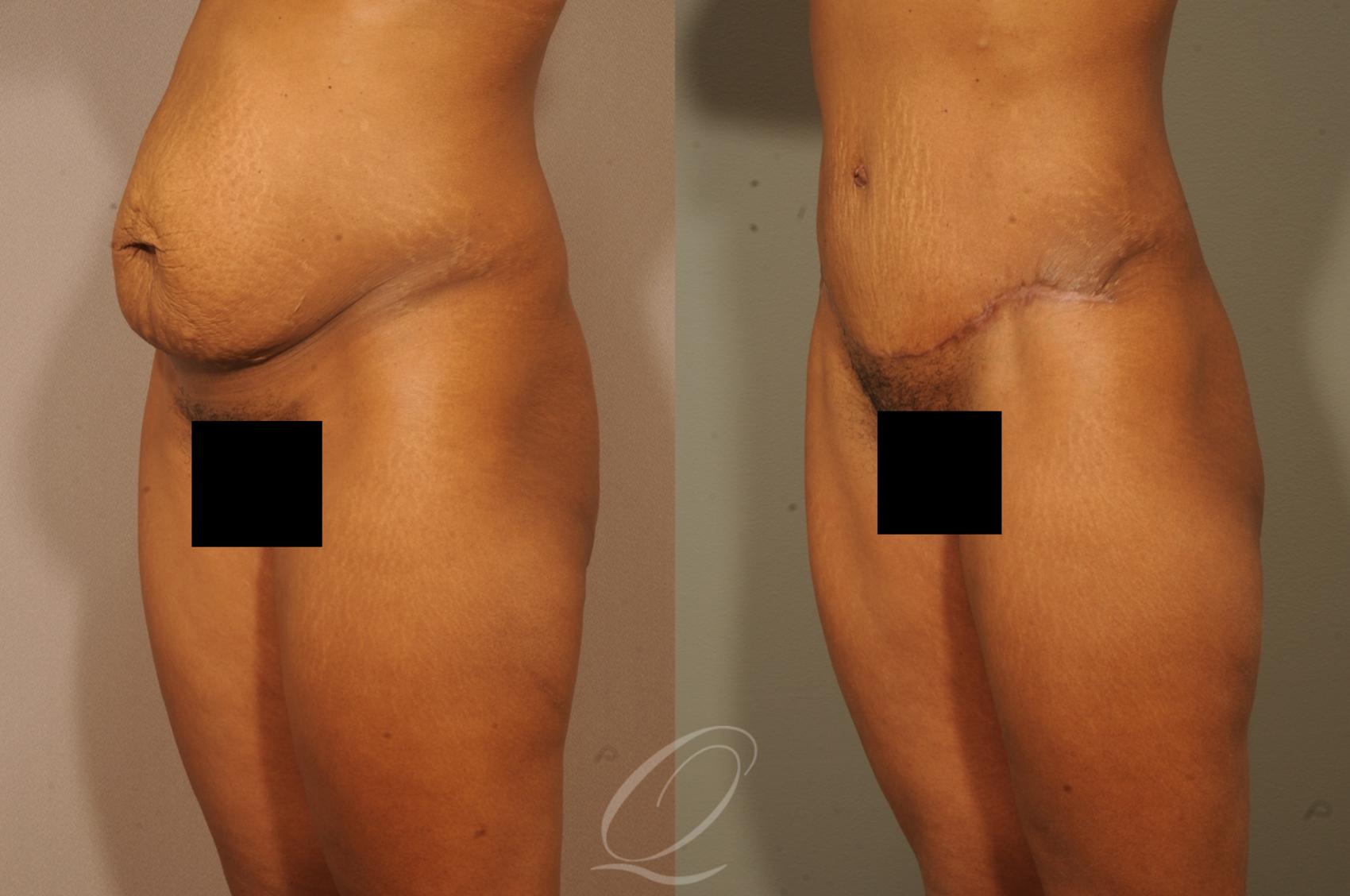 Tummy Tuck Case 1513 Before & After View #4 | Serving Rochester, Syracuse & Buffalo, NY | Quatela Center for Plastic Surgery