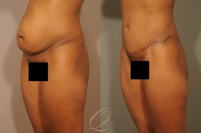 Tummy Tuck Case 1513 Before & After View #4 | Serving Rochester, Syracuse & Buffalo, NY | Quatela Center for Plastic Surgery