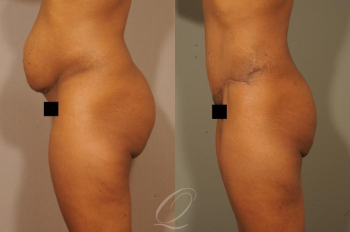 Tummy Tuck Case 1513 Before & After View #5 | Serving Rochester, Syracuse & Buffalo, NY | Quatela Center for Plastic Surgery