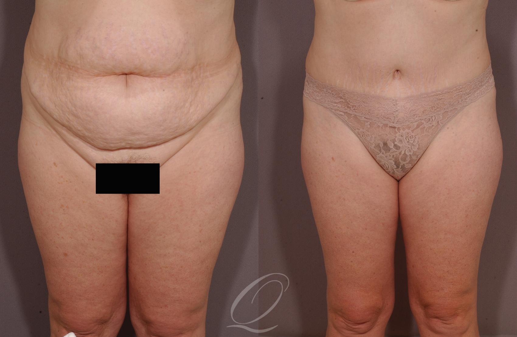 Tummy Tuck Case 152 Before & After View #1 | Serving Rochester, Syracuse & Buffalo, NY | Quatela Center for Plastic Surgery