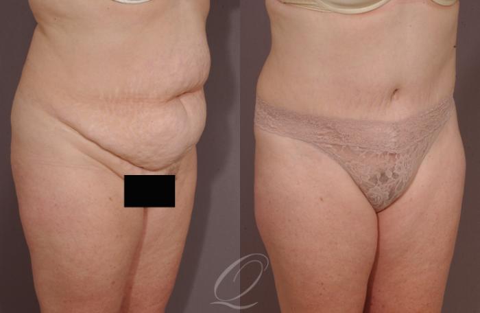 Tummy Tuck Case 152 Before & After View #2 | Serving Rochester, Syracuse & Buffalo, NY | Quatela Center for Plastic Surgery