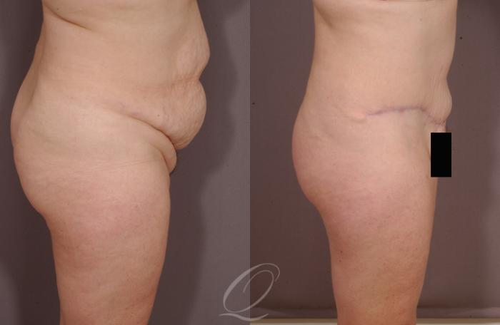 Tummy Tuck Case 152 Before & After View #3 | Serving Rochester, Syracuse & Buffalo, NY | Quatela Center for Plastic Surgery
