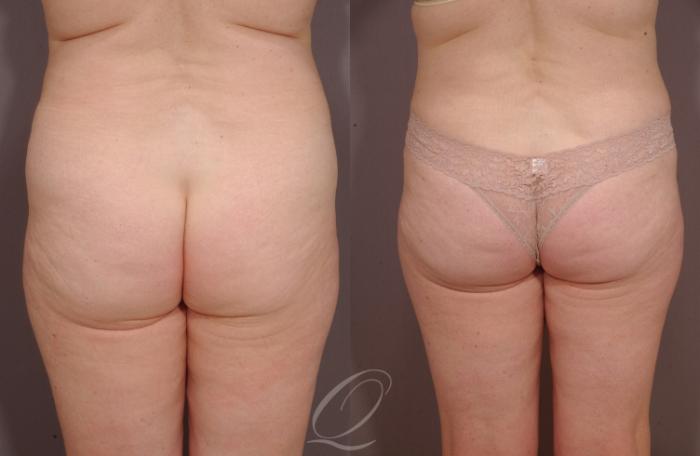 Tummy Tuck Case 152 Before & After View #4 | Serving Rochester, Syracuse & Buffalo, NY | Quatela Center for Plastic Surgery