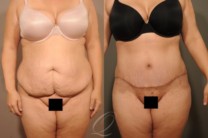 Tummy Tuck Case 1520 Before & After View #1 | Serving Rochester, Syracuse & Buffalo, NY | Quatela Center for Plastic Surgery