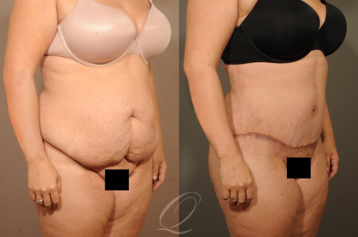 Tummy Tuck Case 1520 Before & After View #2 | Serving Rochester, Syracuse & Buffalo, NY | Quatela Center for Plastic Surgery
