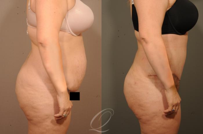 Tummy Tuck Case 1520 Before & After View #3 | Serving Rochester, Syracuse & Buffalo, NY | Quatela Center for Plastic Surgery