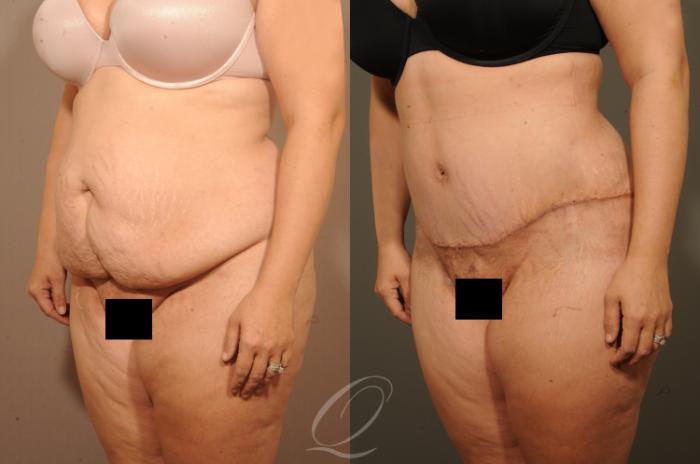 Tummy Tuck Case 1520 Before & After View #4 | Serving Rochester, Syracuse & Buffalo, NY | Quatela Center for Plastic Surgery