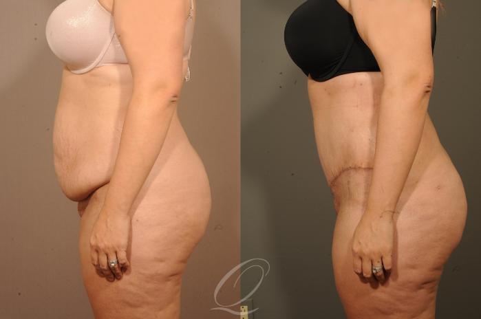 Tummy Tuck Case 1520 Before & After View #5 | Serving Rochester, Syracuse & Buffalo, NY | Quatela Center for Plastic Surgery