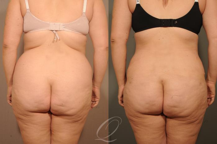 Tummy Tuck Case 1520 Before & After View #6 | Serving Rochester, Syracuse & Buffalo, NY | Quatela Center for Plastic Surgery