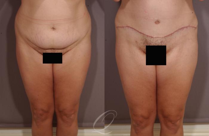 Tummy Tuck Case 153 Before & After View #1 | Serving Rochester, Syracuse & Buffalo, NY | Quatela Center for Plastic Surgery