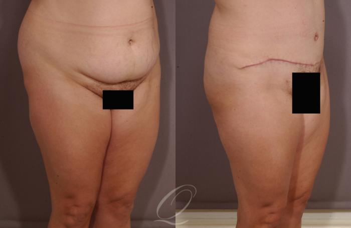 Tummy Tuck Case 153 Before & After View #2 | Serving Rochester, Syracuse & Buffalo, NY | Quatela Center for Plastic Surgery
