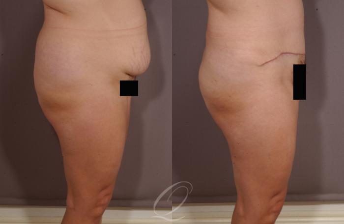 Tummy Tuck Case 153 Before & After View #3 | Serving Rochester, Syracuse & Buffalo, NY | Quatela Center for Plastic Surgery
