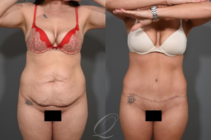 Tummy Tuck Case 1532 Before & After Front | Serving Rochester, Syracuse & Buffalo, NY | Quatela Center for Plastic Surgery