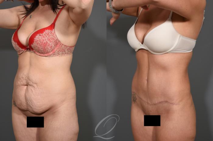 Tummy Tuck Case 1532 Before & After Left Oblique | Serving Rochester, Syracuse & Buffalo, NY | Quatela Center for Plastic Surgery