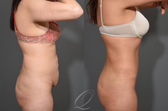 Tummy Tuck Case 1532 Before & After Right Side | Serving Rochester, Syracuse & Buffalo, NY | Quatela Center for Plastic Surgery