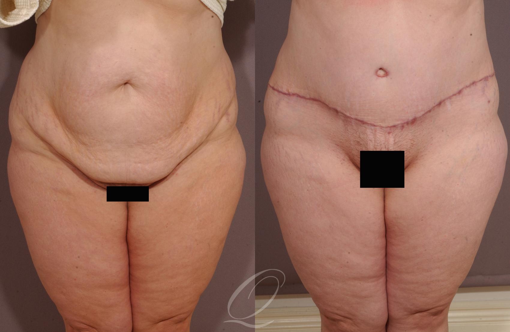 Tummy Tuck Case 155 Before & After View #1 | Serving Rochester, Syracuse & Buffalo, NY | Quatela Center for Plastic Surgery