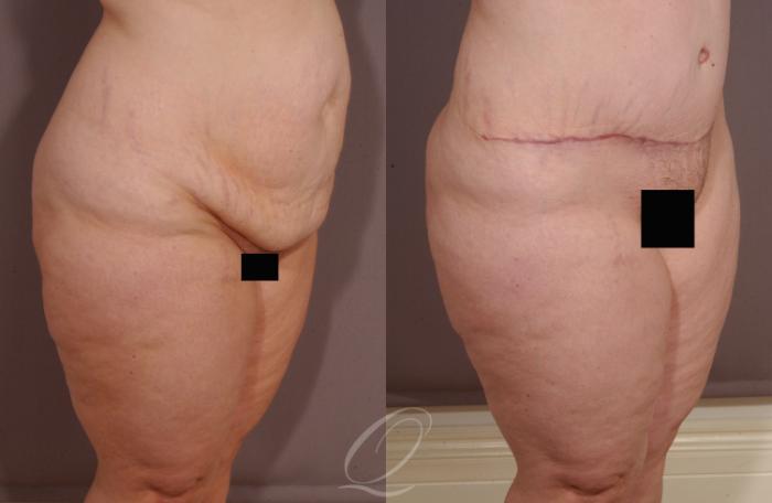 Tummy Tuck Case 155 Before & After View #2 | Serving Rochester, Syracuse & Buffalo, NY | Quatela Center for Plastic Surgery