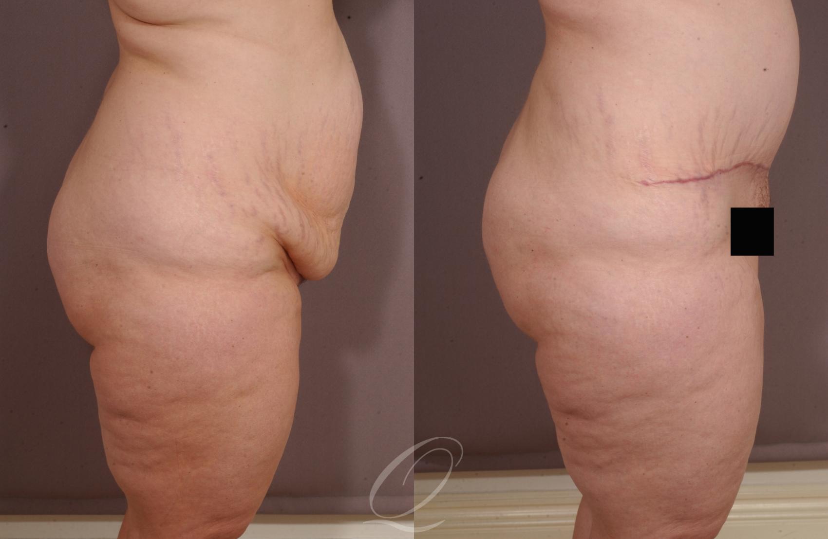 Tummy Tuck Before & After Photos Patient 155