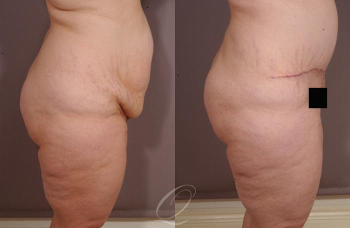 Tummy Tuck Case 155 Before & After View #3 | Serving Rochester, Syracuse & Buffalo, NY | Quatela Center for Plastic Surgery