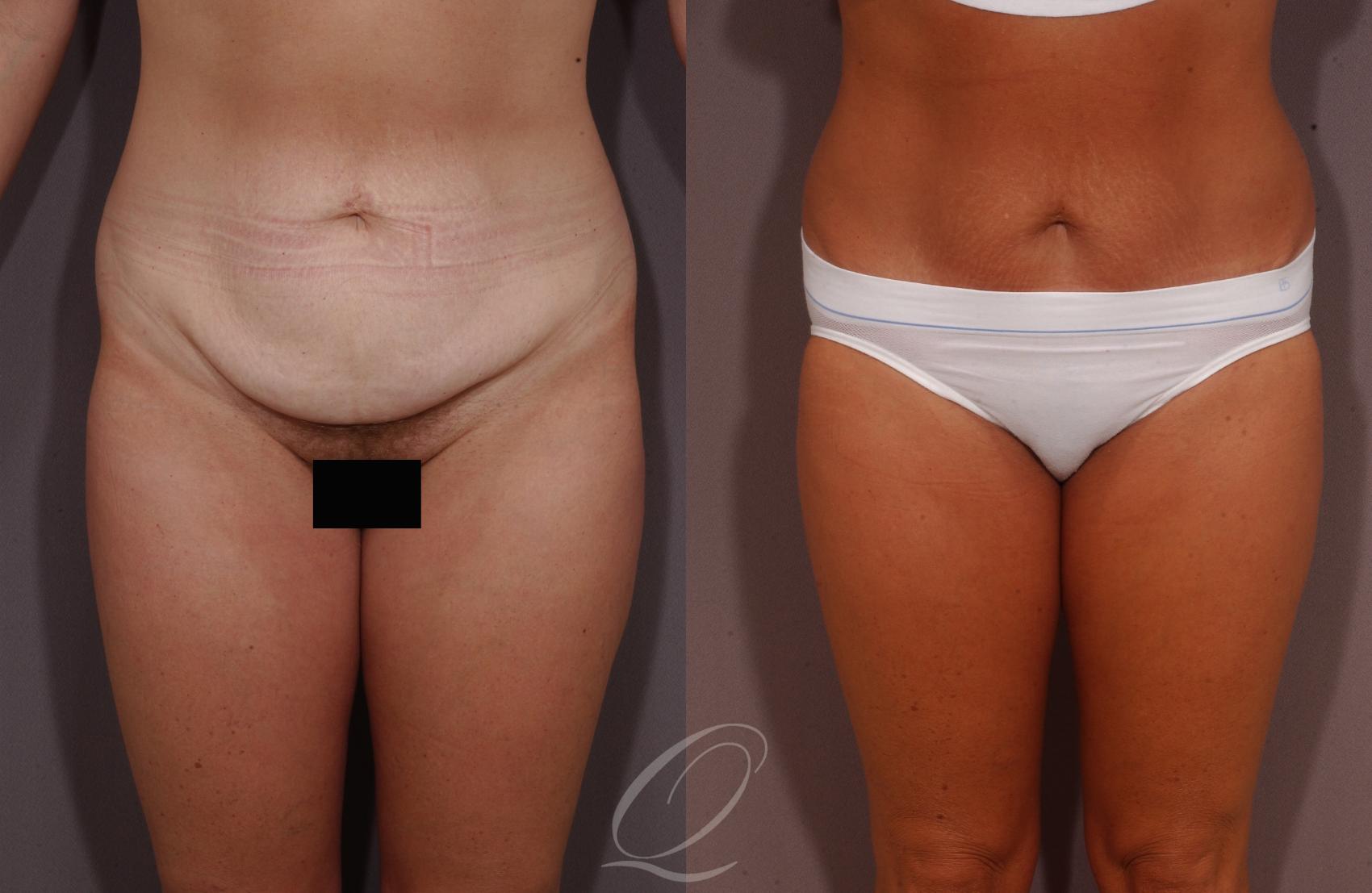 Tummy Tuck Case 156 Before & After View #1 | Serving Rochester, Syracuse & Buffalo, NY | Quatela Center for Plastic Surgery