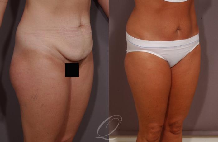 Tummy Tuck Case 156 Before & After View #2 | Serving Rochester, Syracuse & Buffalo, NY | Quatela Center for Plastic Surgery