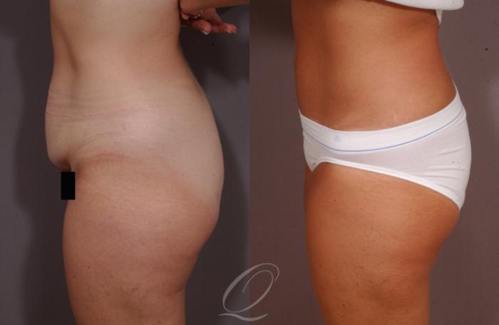Tummy Tuck Case 156 Before & After View #3 | Serving Rochester, Syracuse & Buffalo, NY | Quatela Center for Plastic Surgery