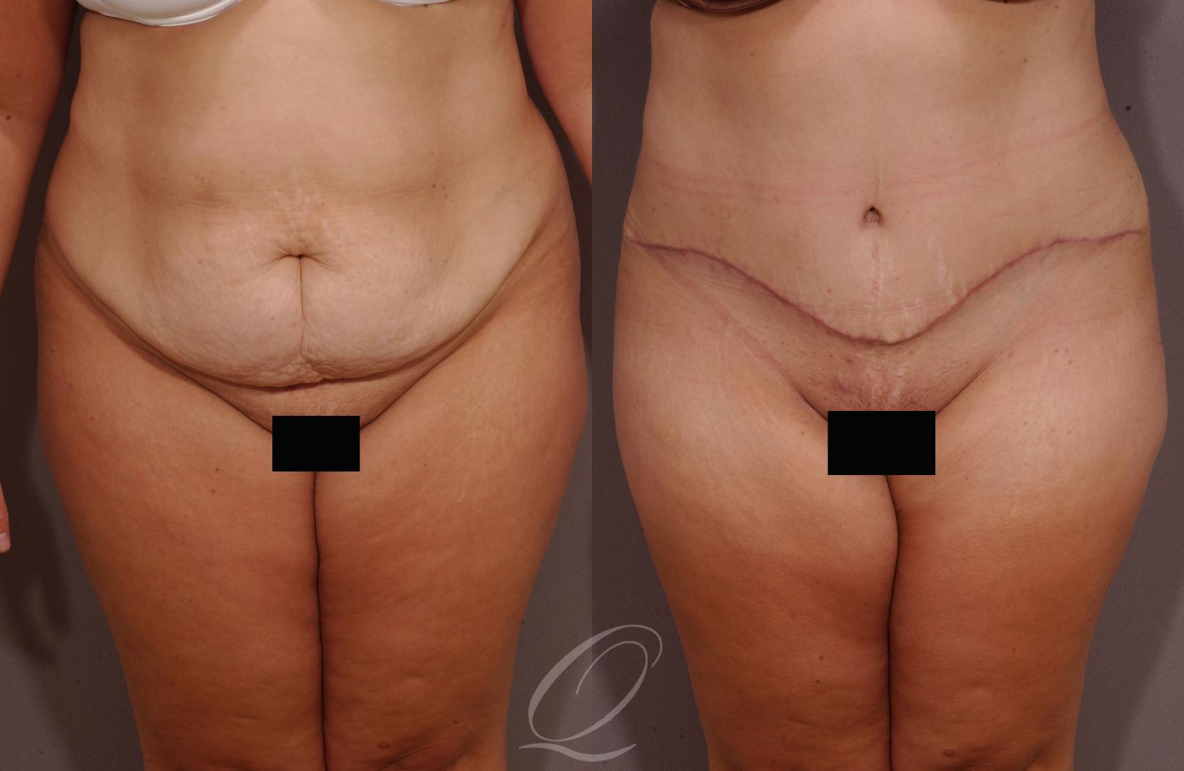 Tummy Tuck Case 157 Before & After View #1 | Serving Rochester, Syracuse & Buffalo, NY | Quatela Center for Plastic Surgery