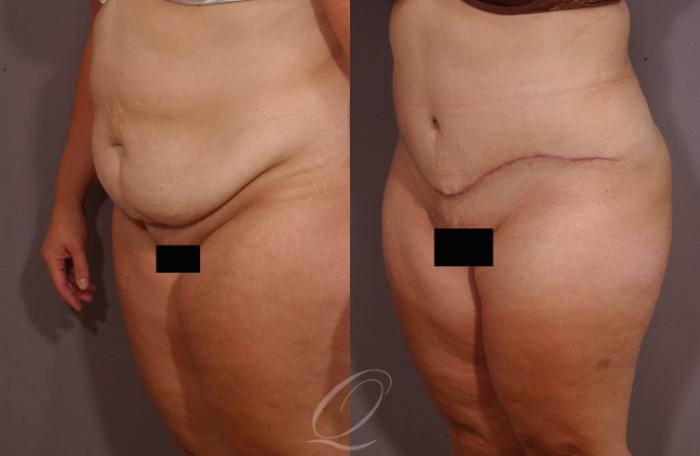 Tummy Tuck Case 157 Before & After View #2 | Serving Rochester, Syracuse & Buffalo, NY | Quatela Center for Plastic Surgery