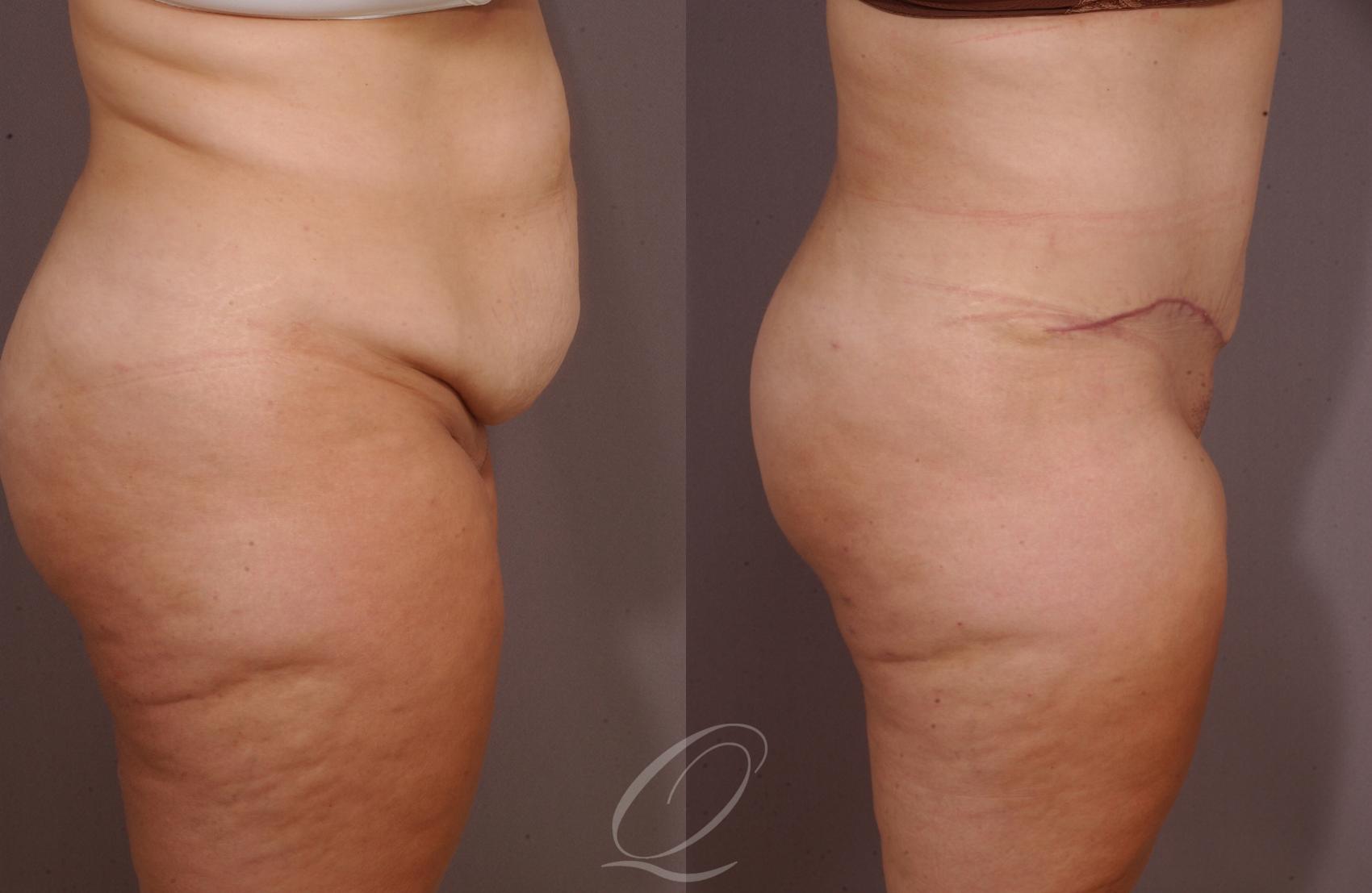 Tummy Tuck Case 157 Before & After View #3 | Serving Rochester, Syracuse & Buffalo, NY | Quatela Center for Plastic Surgery
