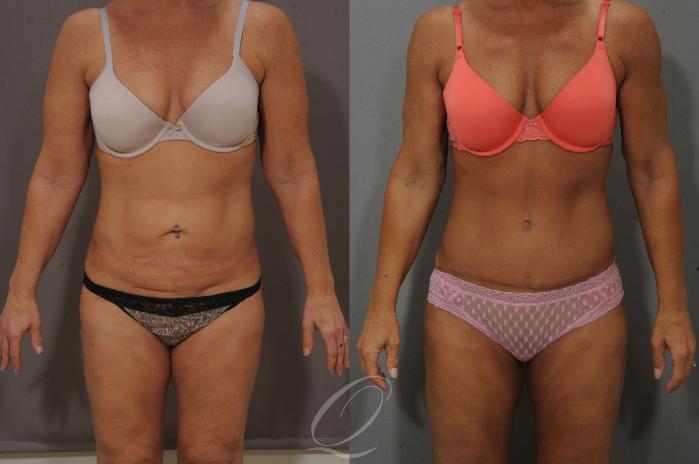 Tummy Tuck Case 158 Before & After View #1 | Serving Rochester, Syracuse & Buffalo, NY | Quatela Center for Plastic Surgery