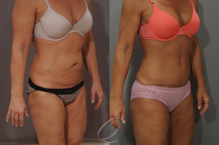 Tummy Tuck Case 158 Before & After View #2 | Serving Rochester, Syracuse & Buffalo, NY | Quatela Center for Plastic Surgery