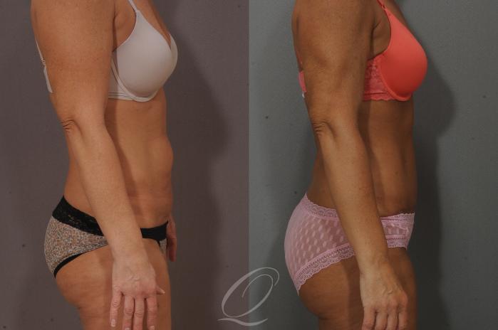 Tummy Tuck Case 158 Before & After View #3 | Serving Rochester, Syracuse & Buffalo, NY | Quatela Center for Plastic Surgery