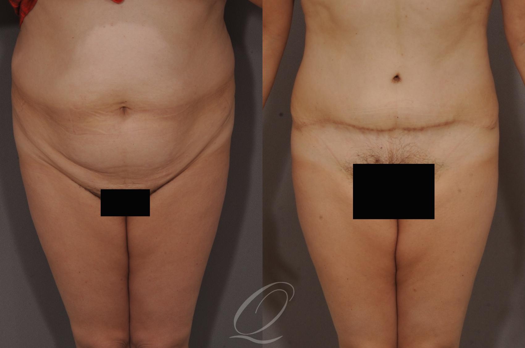 Tummy Tuck Case 159 Before & After View #1 | Serving Rochester, Syracuse & Buffalo, NY | Quatela Center for Plastic Surgery