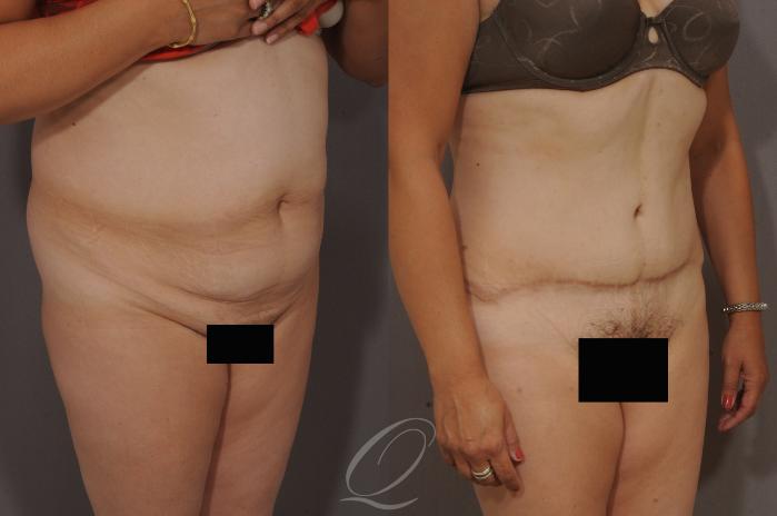 Tummy Tuck Case 159 Before & After View #2 | Serving Rochester, Syracuse & Buffalo, NY | Quatela Center for Plastic Surgery