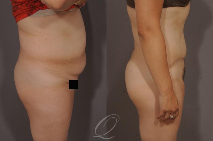 Tummy Tuck Case 159 Before & After View #3 | Serving Rochester, Syracuse & Buffalo, NY | Quatela Center for Plastic Surgery
