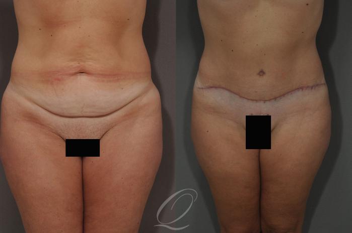 Tummy Tuck Case 222 Before & After View #1 | Serving Rochester, Syracuse & Buffalo, NY | Quatela Center for Plastic Surgery