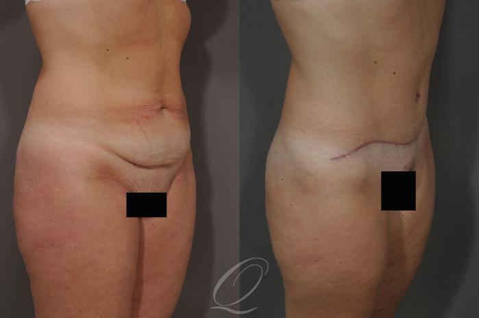 Tummy Tuck Case 222 Before & After View #2 | Serving Rochester, Syracuse & Buffalo, NY | Quatela Center for Plastic Surgery