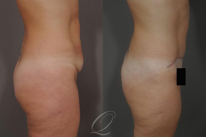 Tummy Tuck Case 222 Before & After View #3 | Serving Rochester, Syracuse & Buffalo, NY | Quatela Center for Plastic Surgery