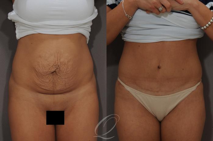 Tummy Tuck Case 268 Before & After View #1 | Serving Rochester, Syracuse & Buffalo, NY | Quatela Center for Plastic Surgery