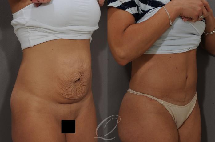 Tummy Tuck Case 268 Before & After View #2 | Serving Rochester, Syracuse & Buffalo, NY | Quatela Center for Plastic Surgery