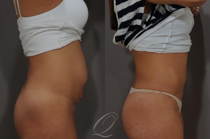 Tummy Tuck Case 268 Before & After View #3 | Serving Rochester, Syracuse & Buffalo, NY | Quatela Center for Plastic Surgery