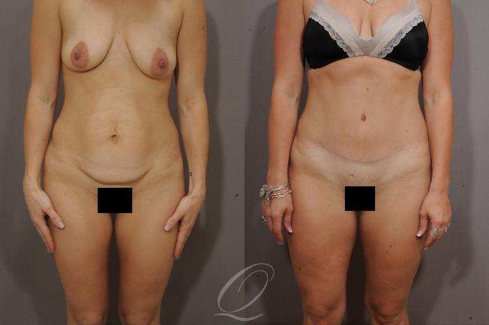 Tummy Tuck Case 269 Before & After View #1 | Serving Rochester, Syracuse & Buffalo, NY | Quatela Center for Plastic Surgery