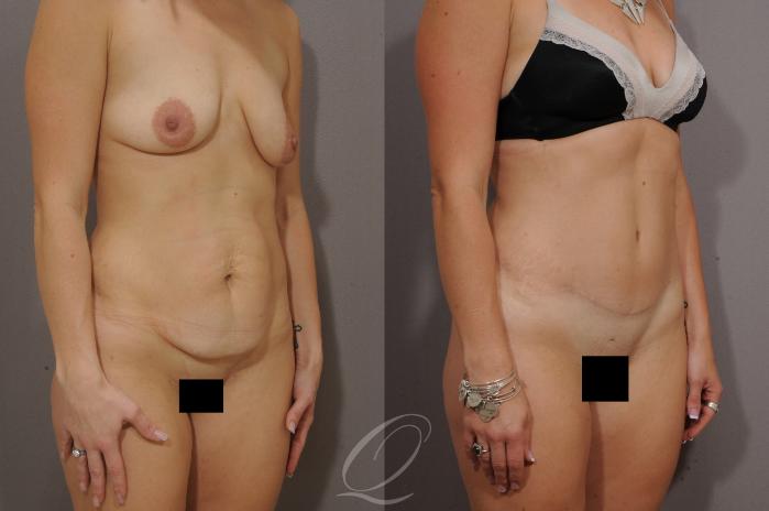 Tummy Tuck Case 269 Before & After View #2 | Serving Rochester, Syracuse & Buffalo, NY | Quatela Center for Plastic Surgery