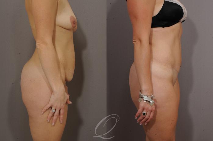 Tummy Tuck Case 269 Before & After View #3 | Serving Rochester, Syracuse & Buffalo, NY | Quatela Center for Plastic Surgery