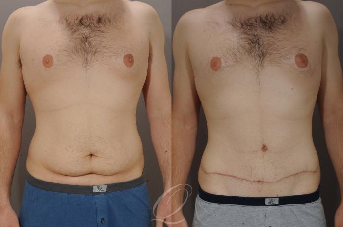 Male Tummy Tuck Case 270 Before & After View #1 | Serving Rochester, Syracuse & Buffalo, NY | Quatela Center for Plastic Surgery