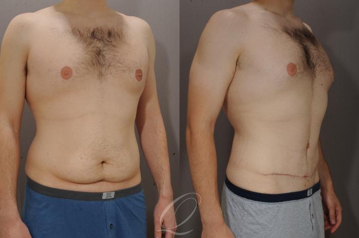 Male Tummy Tuck Case 270 Before & After View #2 | Serving Rochester, Syracuse & Buffalo, NY | Quatela Center for Plastic Surgery