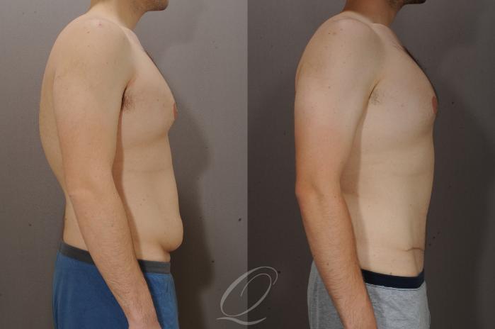 Tummy Tuck Case 270 Before & After View #3 | Serving Rochester, Syracuse & Buffalo, NY | Quatela Center for Plastic Surgery