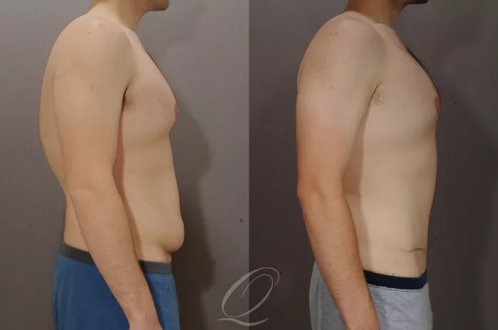 Tummy Tuck Before & After Photos Patient 270, Serving Rochester, Syracuse  & Buffalo, NY