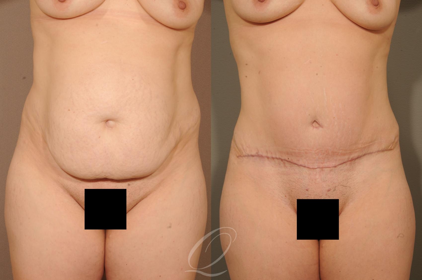 Tummy Tuck Case 279 Before & After View #1 | Serving Rochester, Syracuse & Buffalo, NY | Quatela Center for Plastic Surgery