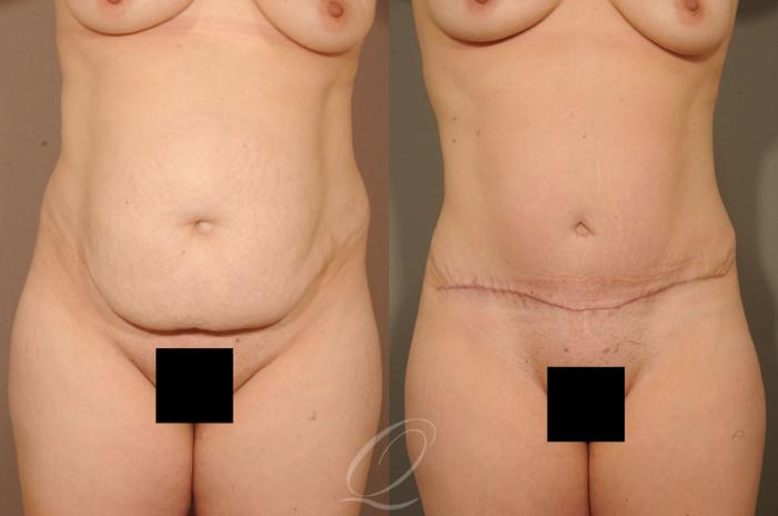 Tummy Tuck Case 279 Before & After View #1 | Serving Rochester, Syracuse & Buffalo, NY | Quatela Center for Plastic Surgery